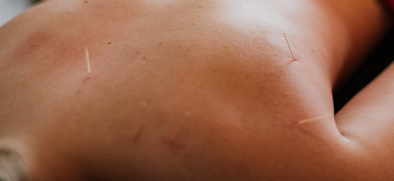 Dry Needling & Cupping
